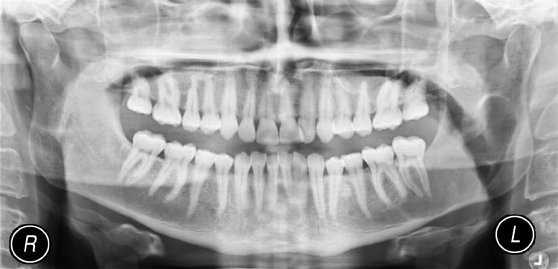 dentista radiografia panoramica ortodonzia apparecchio denti poggibonsi colle val d elsa